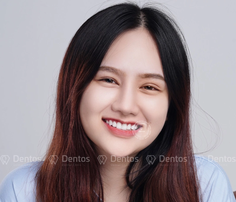 Chi tiết quy trình bọc răng sứ chuẩn y khoa mất bao lâu?